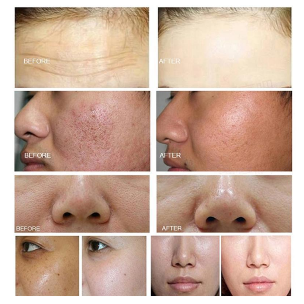 Reafirma, tonifica y rejuvenece tu piel con la tecnología avanzada de HIFU VMAX Radar.